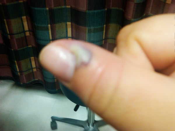 Infected Thumb Before